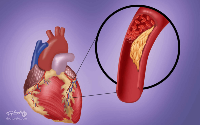 بیماری عروق کرونر، از شایع ترین و خطرناک ترین بیماری های قلبی است. 