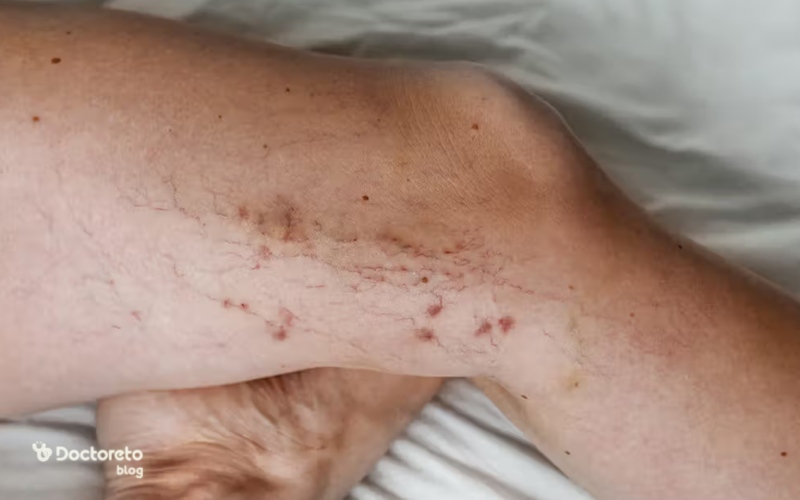 عکس واریس طنابی پا