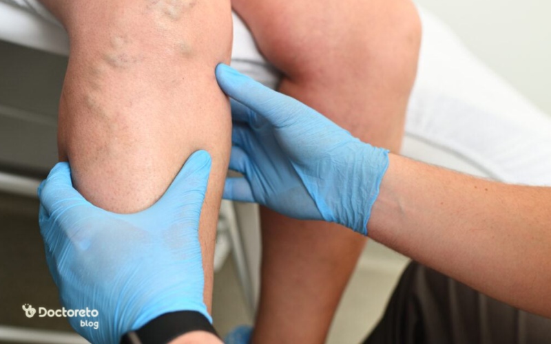 درمان واریس طنابی چیست؟