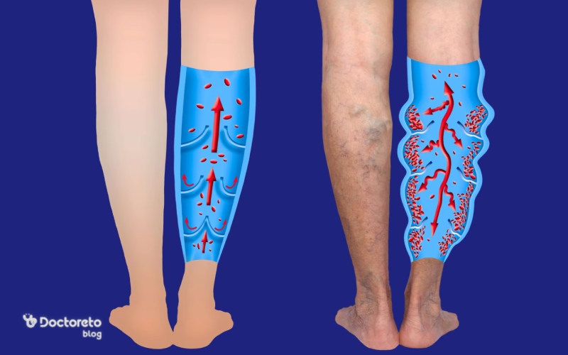 علت واریس طنابی چیست؟