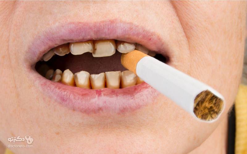 لمینت دندان برای افراد سیگاری غیرممکن نیست اما بیشتر از حالت معمول طول می‌کشد.