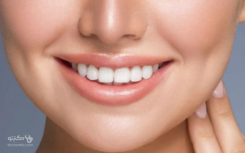 مواد لمینت باعث پوسیدگی دندان نمی‌شود یعنی ضرری برای دندان‌ها ندارند. 