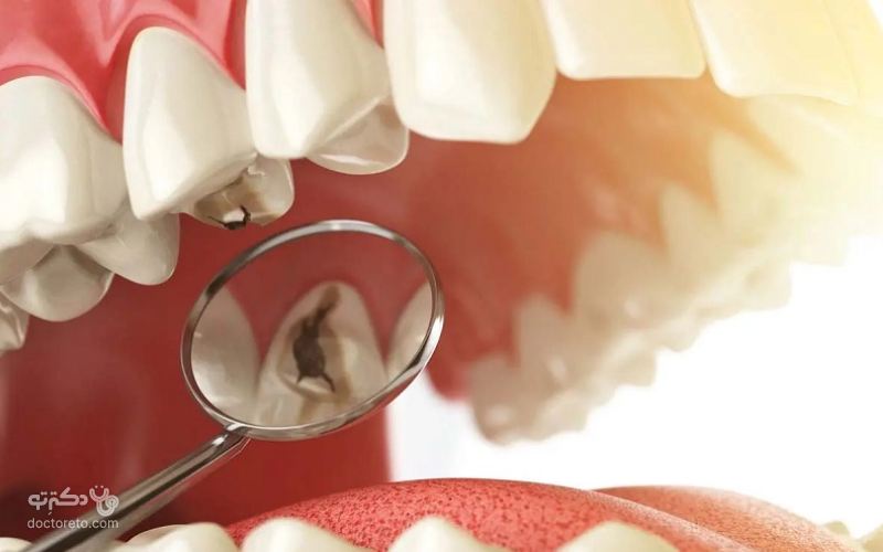 قبل از اینکه لمینت‌ها نصب شوند دندانپزشک باید هرگونه خرابی، پوسیدگی دندان یا آسیب دیدگی را برطرف کند. 