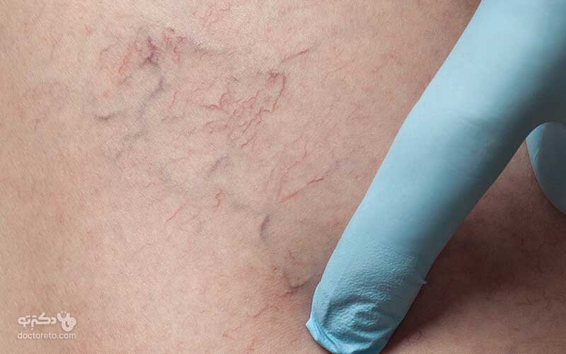 واریس صورت چیست؟