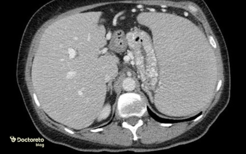 عکس واریس معده