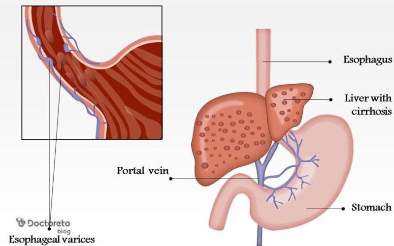 درمان واریس معده چیست؟
