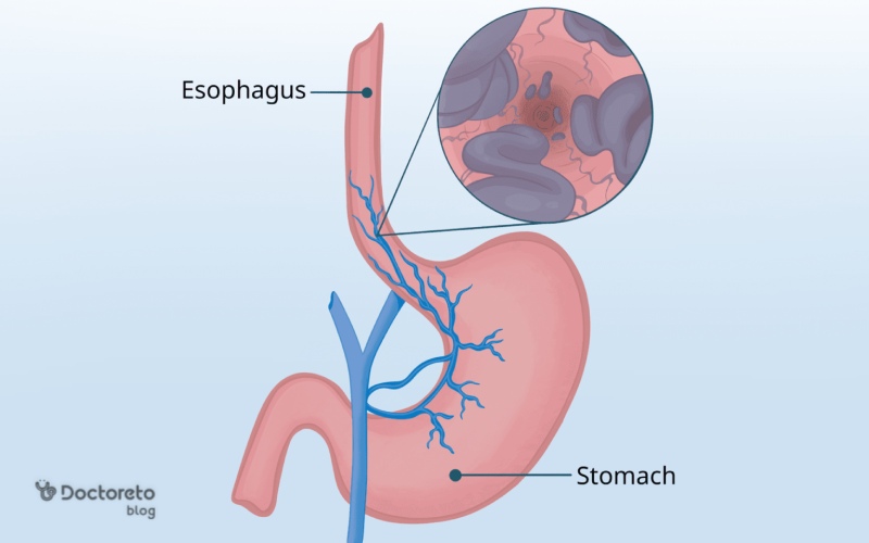 واریس معده چیست؟