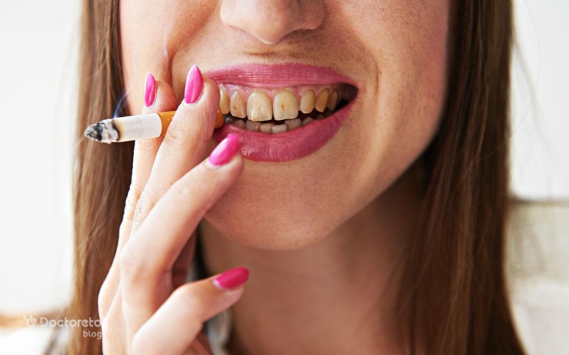 لمینت دندان برای افراد سیگاری چقدر موثر است؟