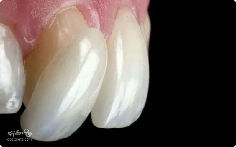 لمینت افتاده دندان فقط توسط دندانپزشک باید چسبانده شود.