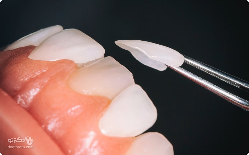 گاهی فشار واردشده به لمینت از دندان‌های کناری باعث افتادن آن می‌شود