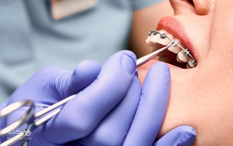 هزینه ارتودنسی یک هزینه کلی است که بسته به مدت‌زمان درمان توسط دندانپزشک مشخص می‌شود. 