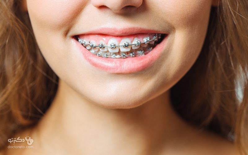  این تکنیک علاوه بر زیبایی دندان‌ها برای اصلاح طرح لبخند و رفع ناهنجاری‌های فک هم قابل استفاده است.