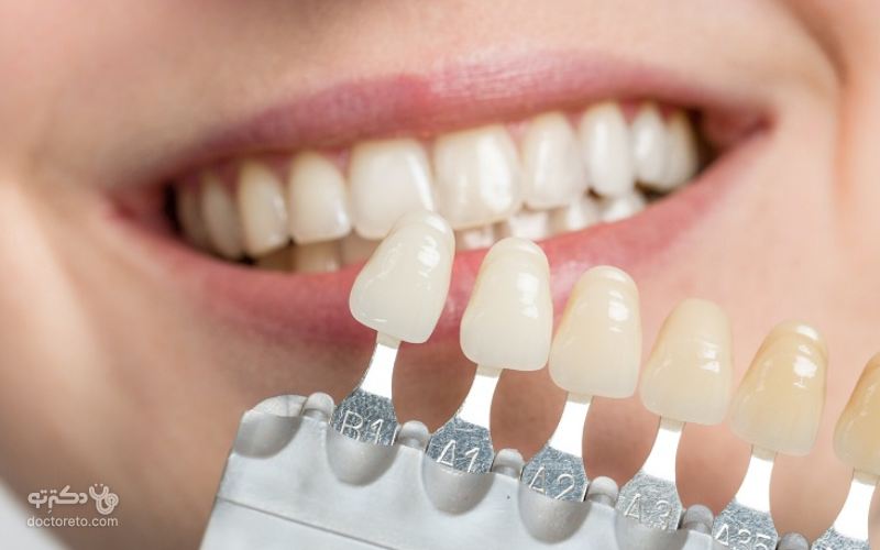 حداکثر عمر مفید لمینت دندان 10 سال است.