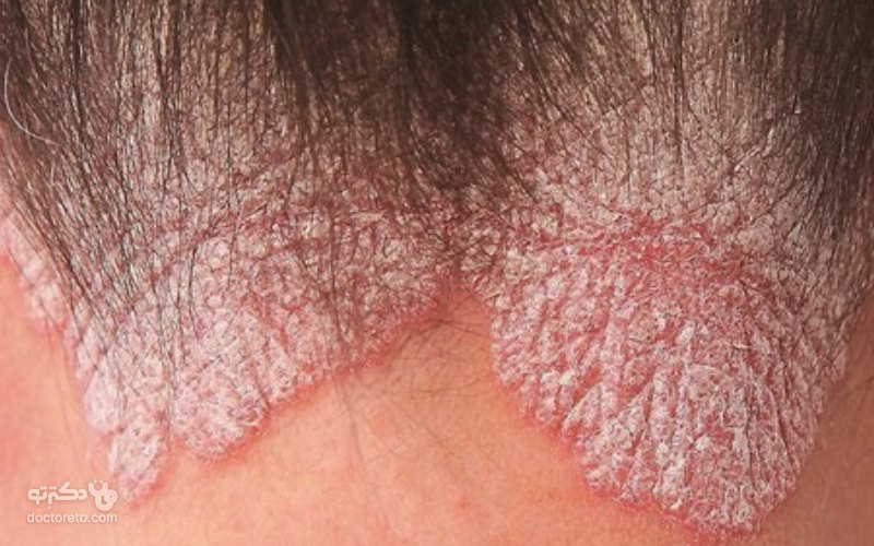 بیماری پسوریازیس می‌ توند سر را درگیر کند و باعث شوره‌ سر و یا ریزش زیاد پوست از سر شود.