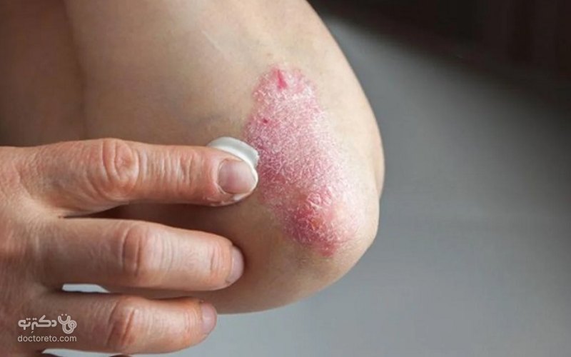 داروی درمانی بیماری پوستی سوریازیس چیست؟