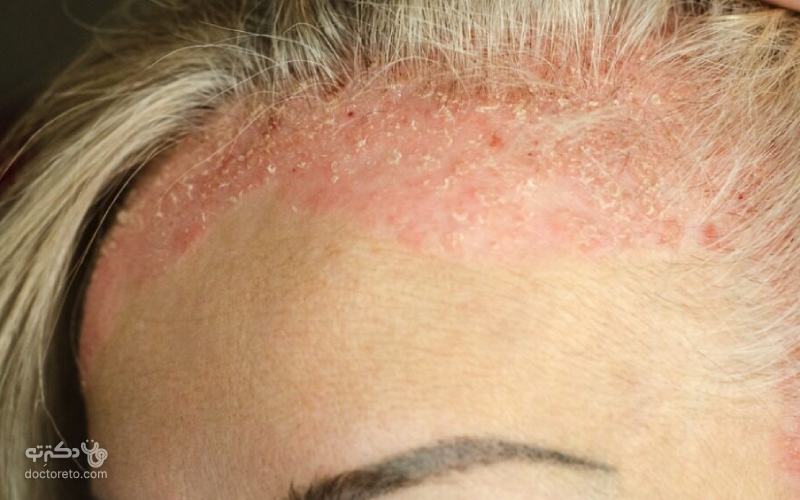 این حالت را می‌ توان با شامپو برای موهای مخصوص پسوریازیس درمان کرد و شرایط را بهتر کرد.