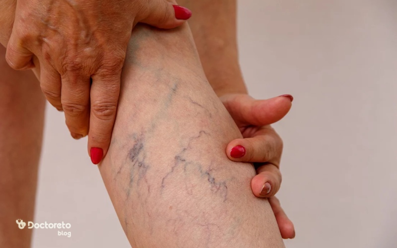 علت رگهای عنکبوتی پا