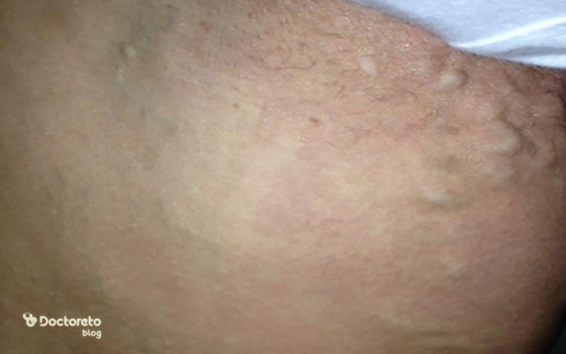 عکس واریس واژن در بارداری