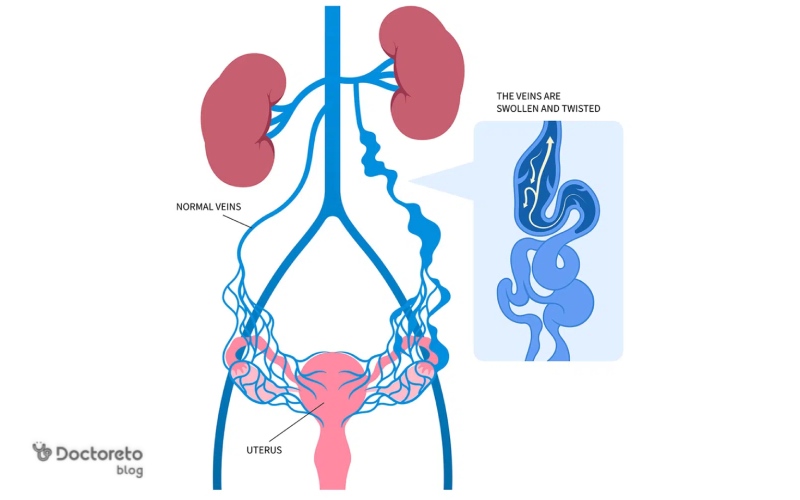 علت واریس واژن در بارداری چیست؟