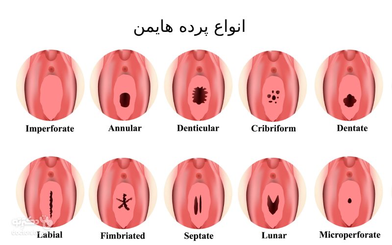 پرده‌ بکارت یک بافت گوشتی نازک در دستگاه تناسلی زنان است که در ابتدای ورودی واژن زن قرار دارد.