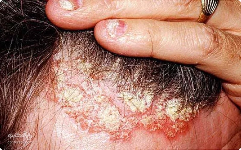 درمان پسوریازیس پوست سر شامل استفاده از شامپو‌های ضد قارچی می‌شود.