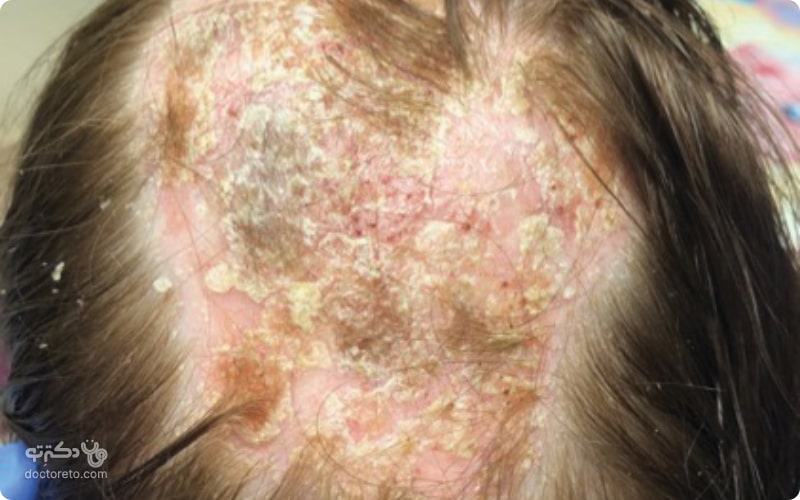 برخی عفونت های قارچی و باکتریایی می‌توانند در بروز پسوریازیس پوست سر نقش داشته باشند.