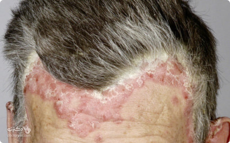 پسوریازیس پوست سر یک بیماری خودایمنی پوستی است که معمولاً به صورت طولانی مدت و مزمن پیش می‌آید.