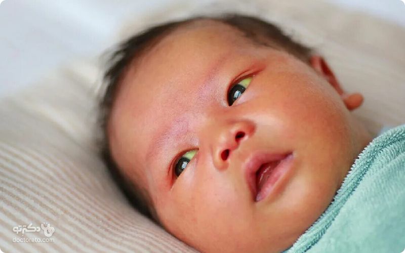 علایم زردی نوزادان چیست؟