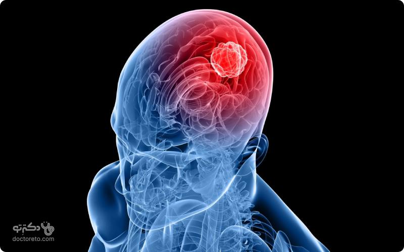 آیا سردرد تومور مغزی خطرناک است؟