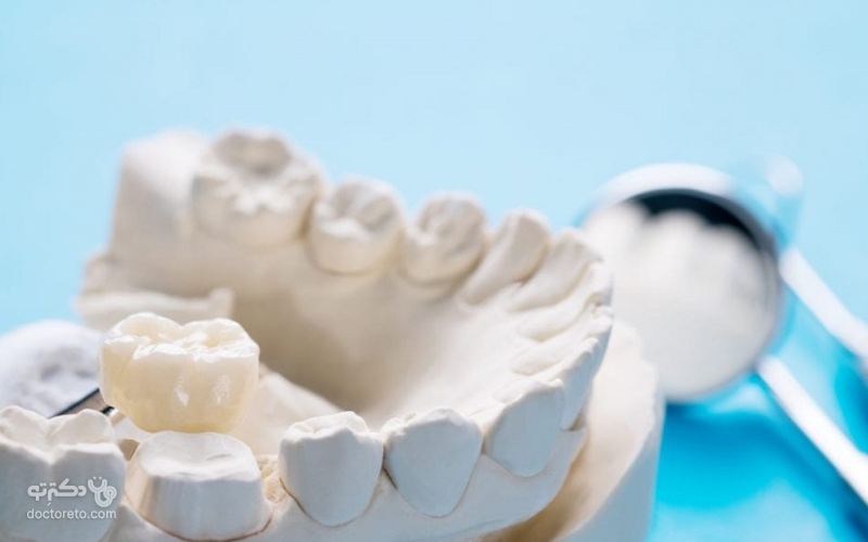 برای دندان‌هایی که دیگر قابل ترمیم نیستند باید از کراون دندان استفاده شود. 