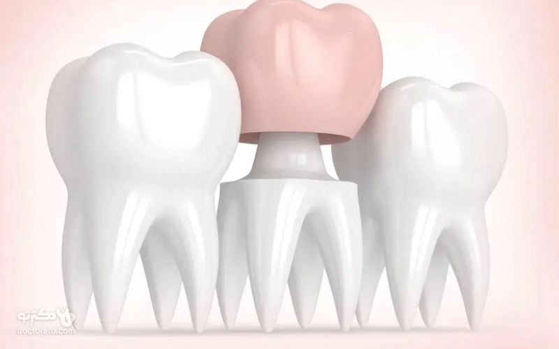 معمولا یک تا 2 هفته بعد روکش کردن دندان احتمالا احساس درد و حساسیت دارید.