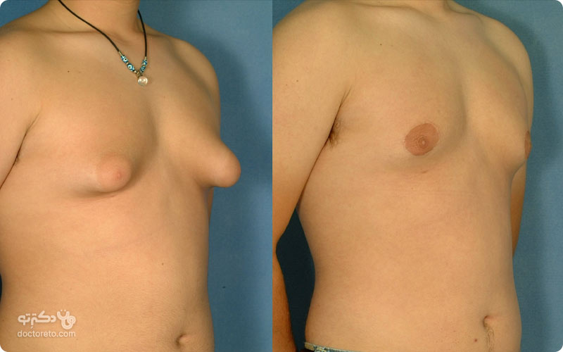ژنیکوماستی باعث بزرگی سینه مردان شده و گاهی نیاز به درمان دارد.
