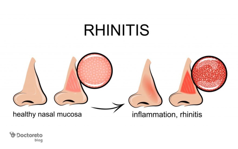 علت رینیت بارداری چیست؟