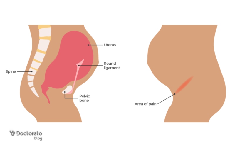 درد رباط گرد در بارداری کجاست؟
