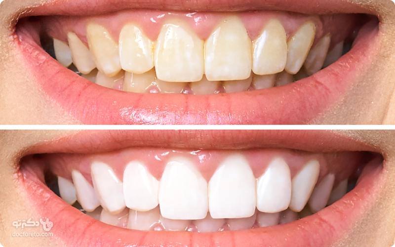 علل تغییر رنگ دندان کدامند؟