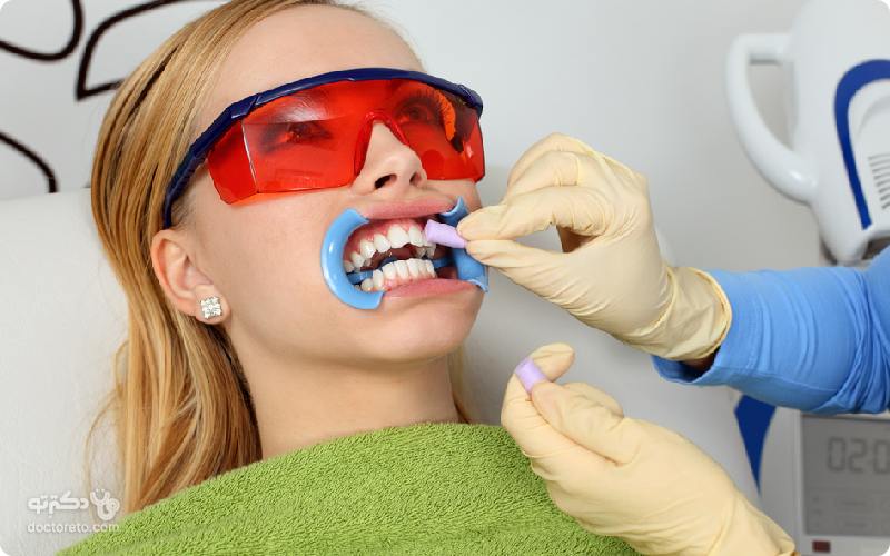 روش سفید کردن دندان چیست؟