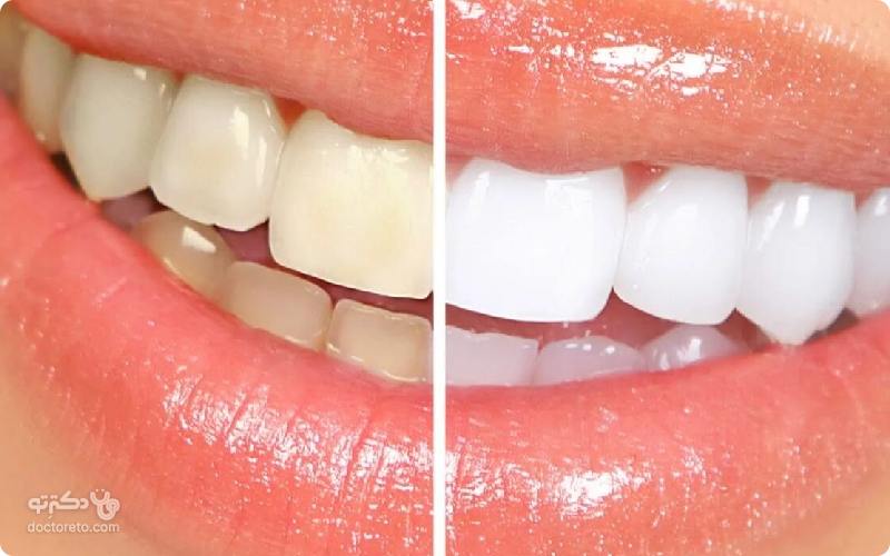 سفید کردن دندان با نمک امکان دارد؟