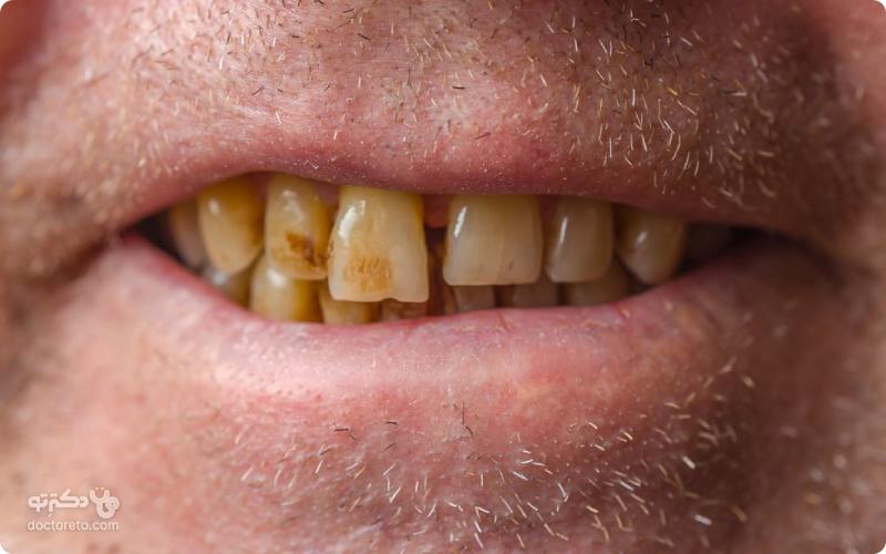 روش سفید شدن دندان افراد سیگاری چیست؟