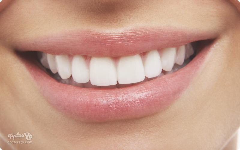 کیت سفید کننده دندان چیست؟