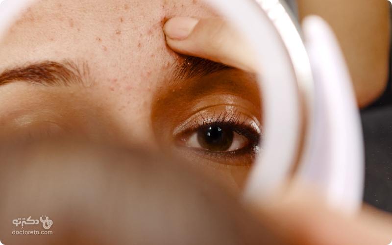 درمان جوش صورت با راکوتان چگونه است؟