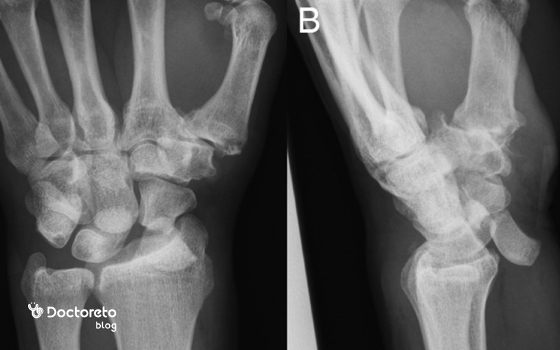 عکس در رفتگی مچ دست