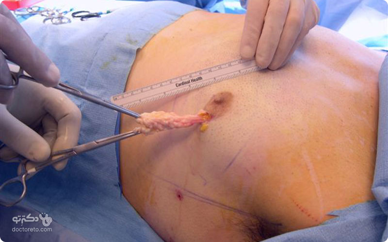 در این تصویر می‌توانید خارج کردن بافت سینه را در حین عمل مشاهده کنید.