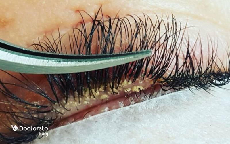 درمان عفونت چشم بعد از کاشت مژه