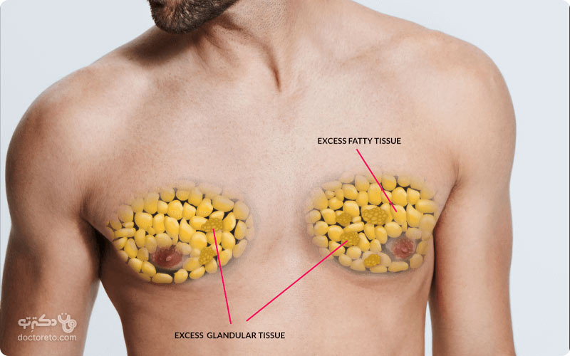 اگر بزرگی سینه در مردان مربوط به افزایش چربی باشد، می‌توان با عمل لیپوماتیک چربی را خارج کرد.