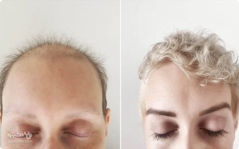 بعد از شیمی درمانی موها مجدد رشد می‌کنند. اما ممکن است حالت و رنگ آن تغییر کند.