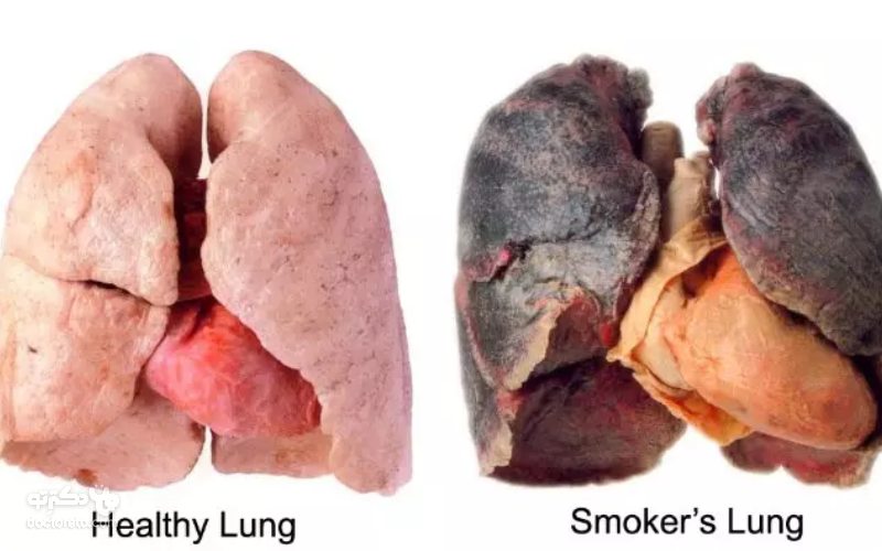 نشانه های سرطان در ریه چیست؟
