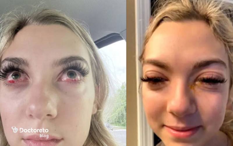 عکس عوارض کاشت مژه