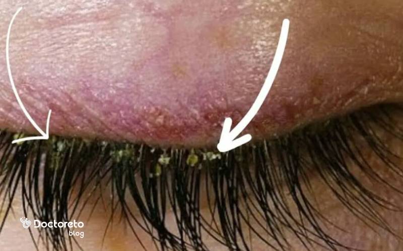 علت درد پلک بعد از اکستنشن مژه