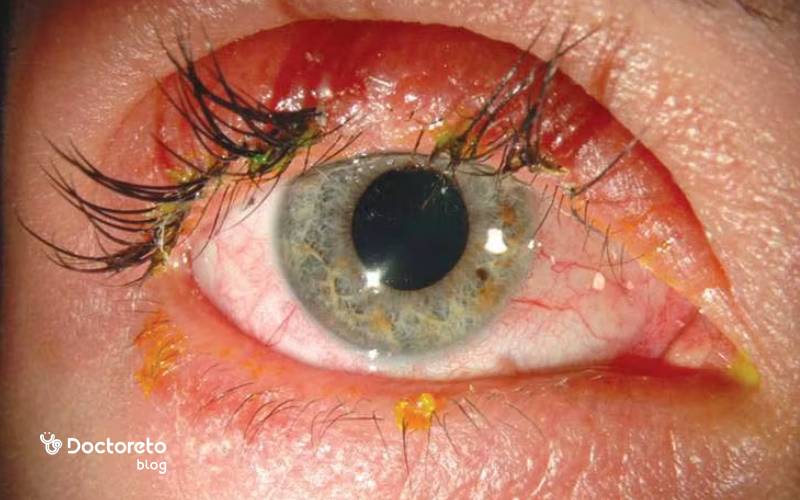 روش های پیشگیری از عوارض کاشت مژه