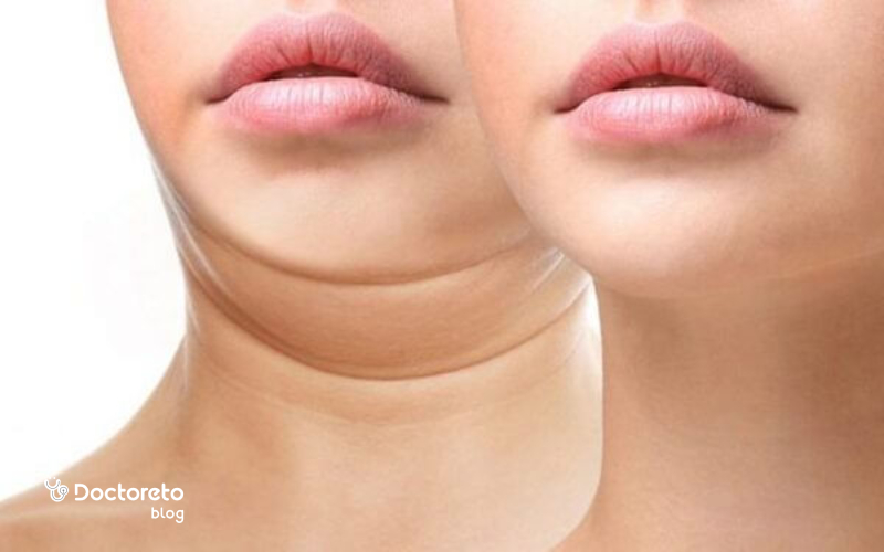 برای زاویه سازی صورت با کیبلا چند جلسه درمان نیاز است؟
